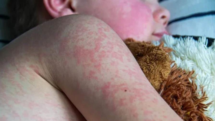 Repunte sarampión Estados Unidos