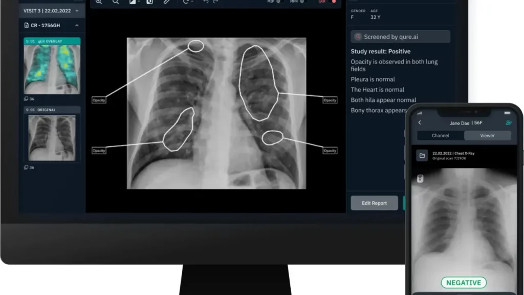 qure ai fc7d61cb focus 0 0 1280 720