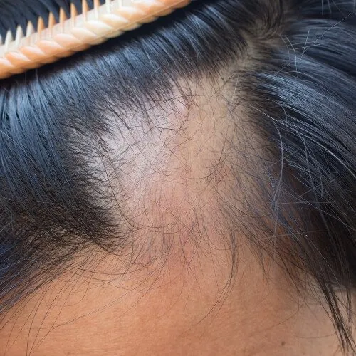 como solucionar la alopecia frontal fibrosante en kuntur clinic clinica capilar de barcelona