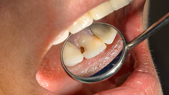 caries frontal tooth photographed through dental