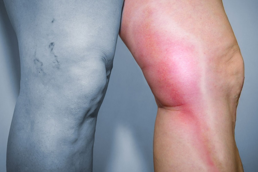 images trombosisvenosa