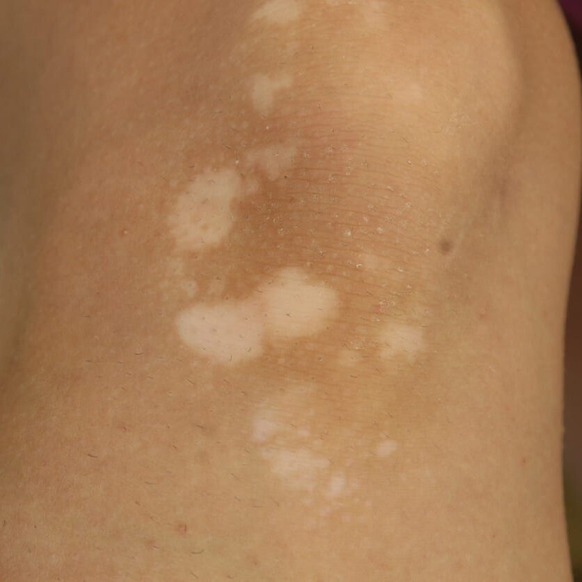 hipomelanosis guttata idiopatica 1