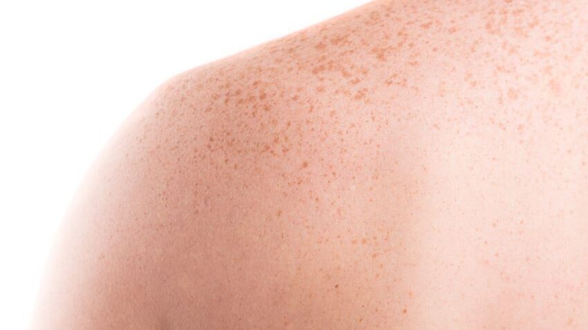 pitiriasis versicolor