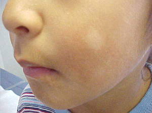 pityriasis alba